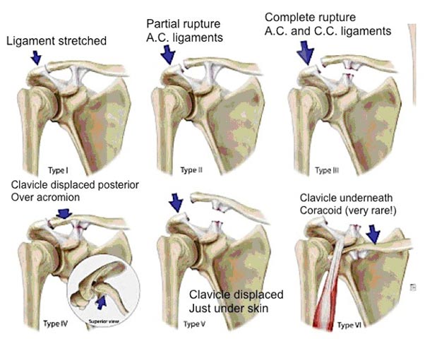 AC joint dislocation